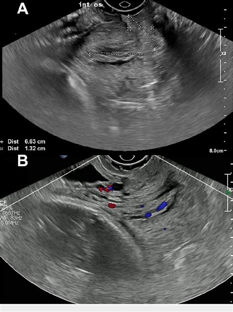 Figure 1 from Role of Ultrasound in Managing Cervical Polyps During ...