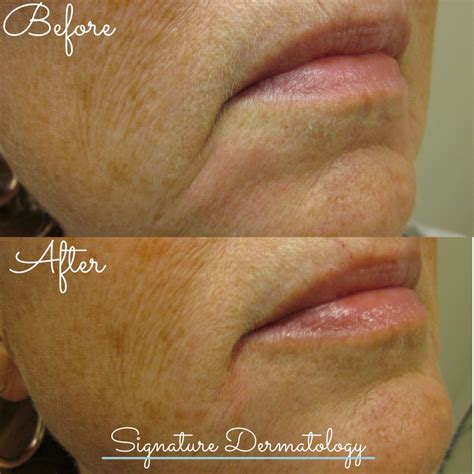 Marionette Lines Before and After | Signature Dermatology