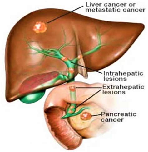 Bile Duct Obstruction Surgery | Renew Physical Therapy