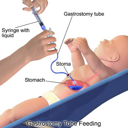 Bolus | Definition & Administration | Study.com