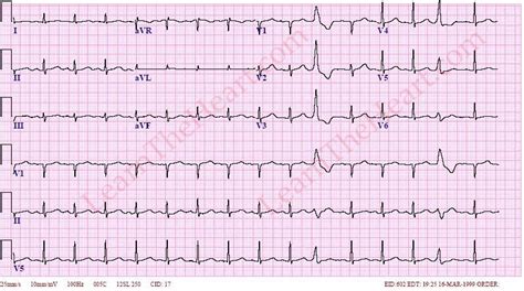 Premature Ventricular Contractions or PVCs ECG Example 3 ...