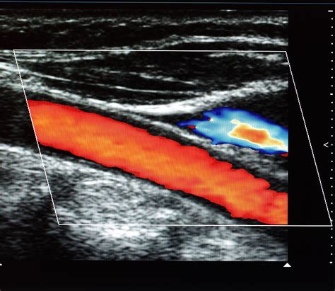 CAROTID ULTRASOUND 2 | Carolina Primary Care : Carolina Primary Care