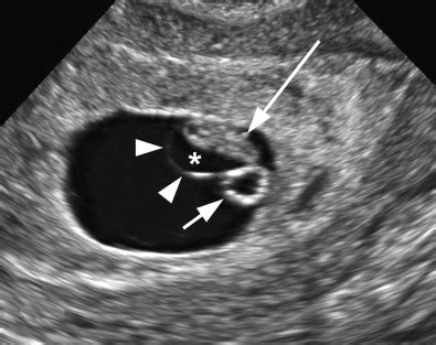 Ultrasound of the Early First Trimester | Radiology Key