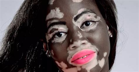 Self-conscious nurse with vitiligo skin condition becomes stunning fashion model after years of ...