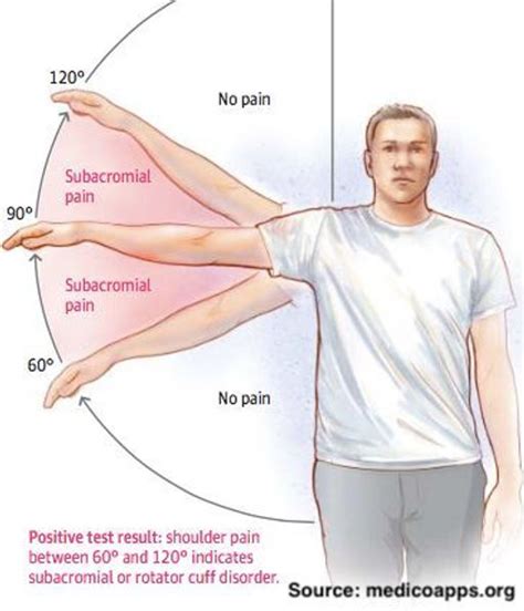 Wizard reader international rotator cuff tendinosis symptoms plans Cradle Sea anemone