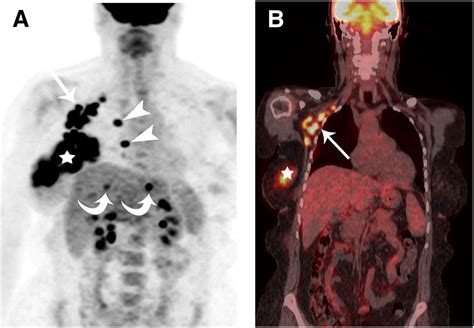 Retrospective Study of 18F-FDG PET/CT in the Diagnosis of Inflammatory ...