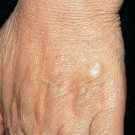 A Freely Movable Subcutaneous Nodule on the Dorsum of the Hand—Quiz ...