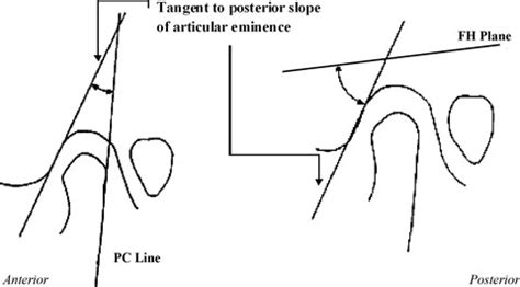 Sagittal section of MRI showing determination of eminence angle ...