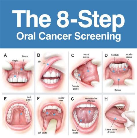 Oral Cancer Awareness – Early Detection is Key – Oral and Maxillofacial ...