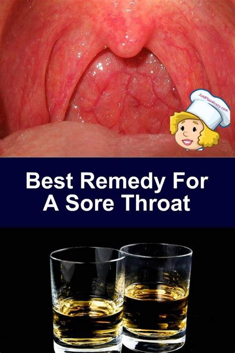 Best Remedy For A Sore Throat | Throat infection, Viral sore throat, Sore throat