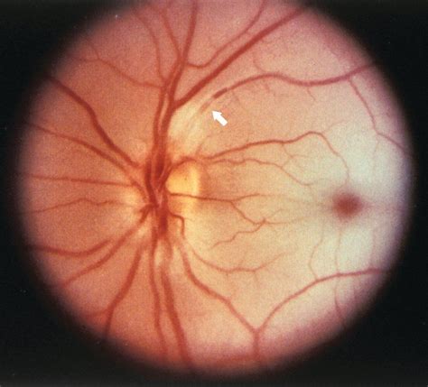 Central retinal artery occlusion is caused by thrombi or emboli. is ...