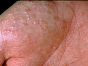 Pompholyx (Vesicular Hand Eczema, Dyshidrotic Eczema) — DermNet