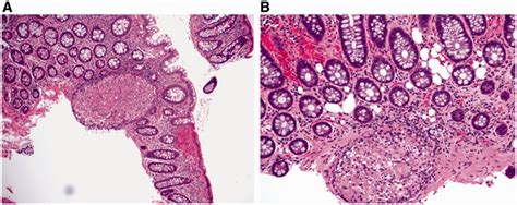 Discrete epithelioid granuloma in Crohn's disease. A: discrete... | Download Scientific Diagram