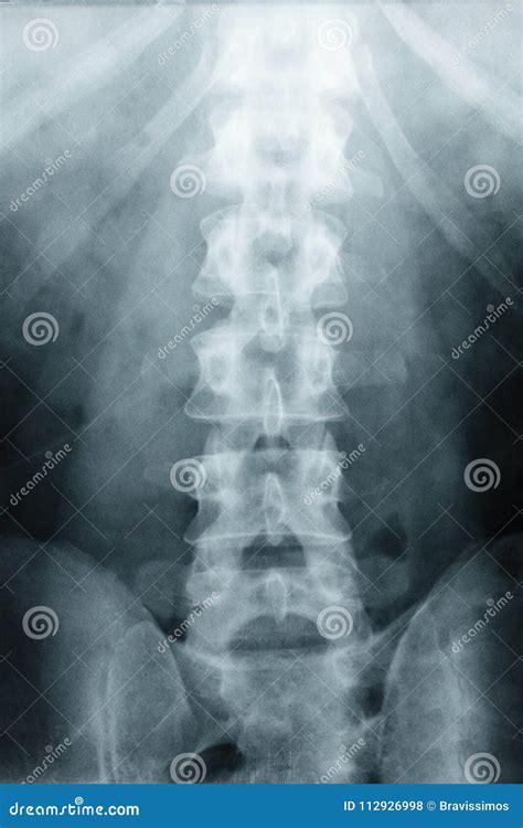 X-ray Scoliosis Film X-ray Lumbar Spine AP Stock Photo - Image of curve, medical: 112926998