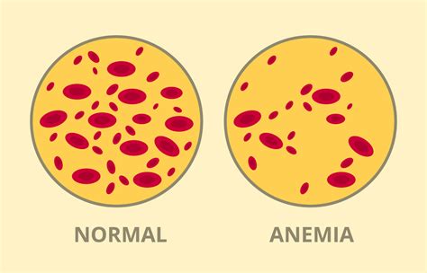 Iron Deficiency Anemia During Pregnancy: Prevention Tips