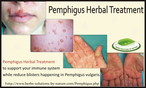 Pemphigus Herbal Treatment - Herbs Solutions By Nature