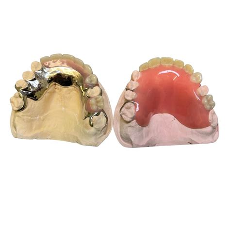 Chrome Partial Dentures, What are the Benefits and Costs? — All Smiles ...