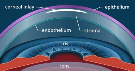 LASIK & presbyopia: Correction with PresbyLASIK | All About Vision