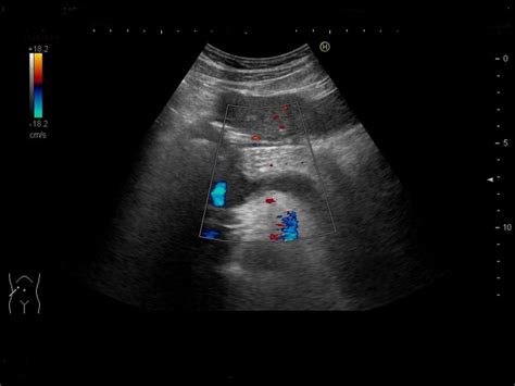 Portal Vein Thrombosis Ultrasound