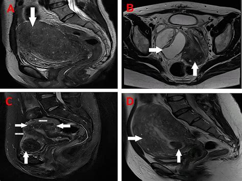 MRI images for different adenomyosis phenotypes and various concomitant... | Download Scientific ...