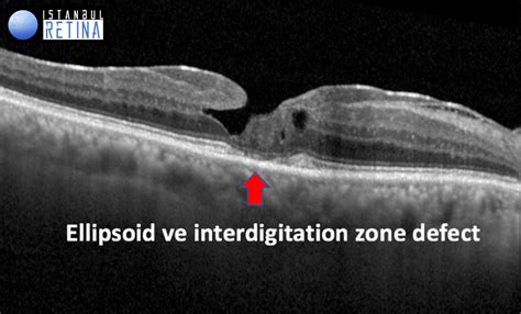 Lamellar Macular Hole and Macular Pseudohole | OCT Club