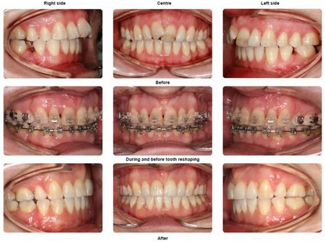 Braces Before and After Photo Gallery - orthodontics