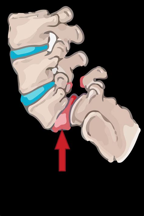 What is Isthmic Spondylolisthesis? Symptoms & Treatments