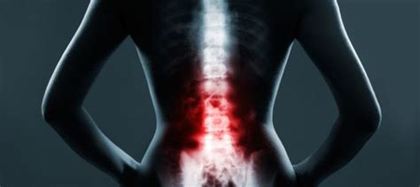 5 Treatment Options For Spinal Arthritis | Minneapolis Spine Surgery