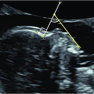 Inferior facial angle (IFA) measurement.... | Download Scientific Diagram