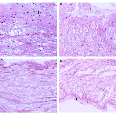 | Electron micrograph of myelin sheath, showing details of lesions in... | Download Scientific ...