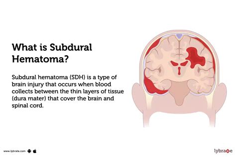 Subdural Hematoma: Causes, Symptoms, Treatment and Cost