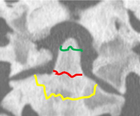 Anderson-Dalonzo classification of dens fracture. Green line: type 1 ...