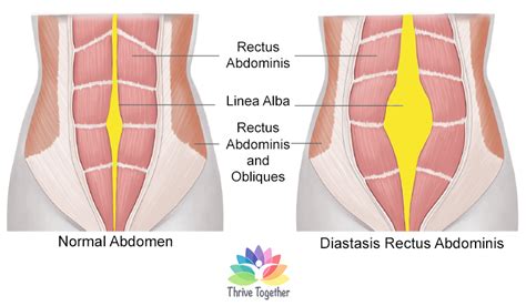 What you need to know about Diastasis Recti | Thrive Together | Women's Fitness