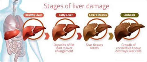 Hepatic encephalopathy causes, signs, symptoms, diagnosis, treatment & prognosis