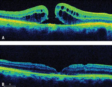 How to Manage Complex Macular Holes