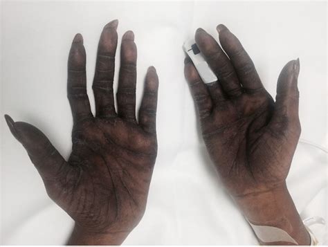 Palmar-plantar erythrodysesthesia | BMJ Case Reports