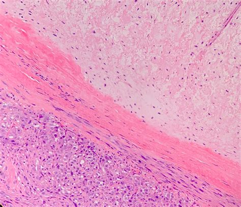 Chondrosarcoma Histology