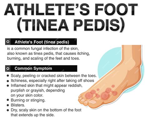 Athlete's Foot Fungus Types and Effective Remedies - Feet Relief