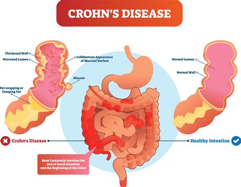 Crohn's Disease: What You Need To Know - Parkland Natural Health in London