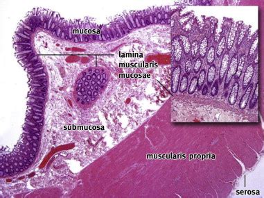 Colon Cancer Histology Images - Pathology Outlines Adenocarcinoma : With a view to the creation ...