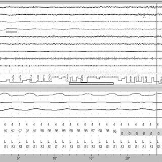 (PDF) Incidence of Serious Adverse Events During Nocturnal Polysomnography