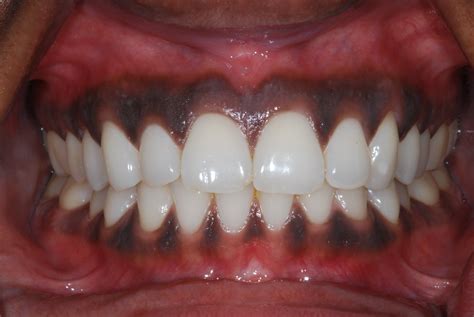 Gum Bleaching – Is it for you? | Dental Implants | Chrysalis Dental Centres Canada