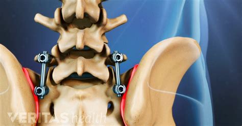 Surgery for Osteoarthritis