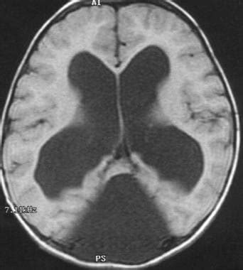 Dandy-Walker Malformation Imaging: Practice Essentials, Radiography ...