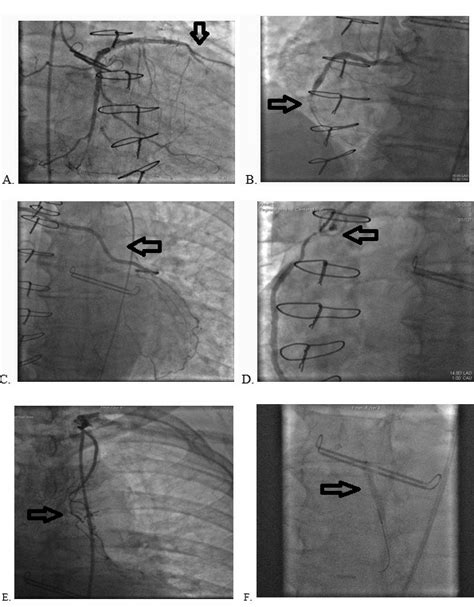 Closure of LIMA and a saphenous vein transplant within a short period of six months after CABG ...