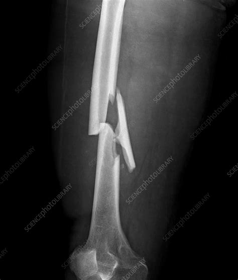 Comminuted femur fracture, X-ray - Stock Image - F035/8734 - Science Photo Library