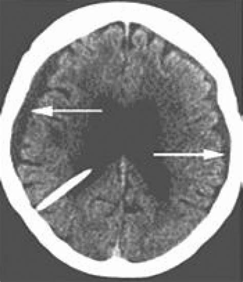 Bilateral subdural hygromas. After placement of a ventriculoperitoneal... | Download Scientific ...