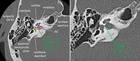 Neuroanatomy TOTD #15🧵 The inner ear #tweetorial--it packs a large functional punch for its ...