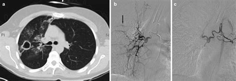 Management of Massive Hemoptysis | Radiology Key