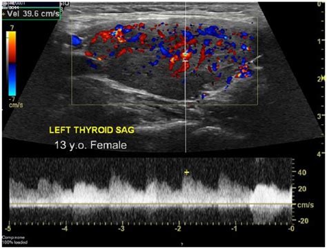 Normal Thyroid Ultrasound